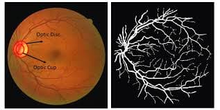RetinaLiteNet: Medical Image Segmentation & Disease Classification